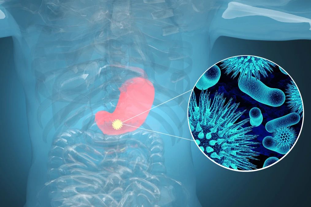 腫瘤標(biāo)記物CA72-4：“胃”，你還好嗎？